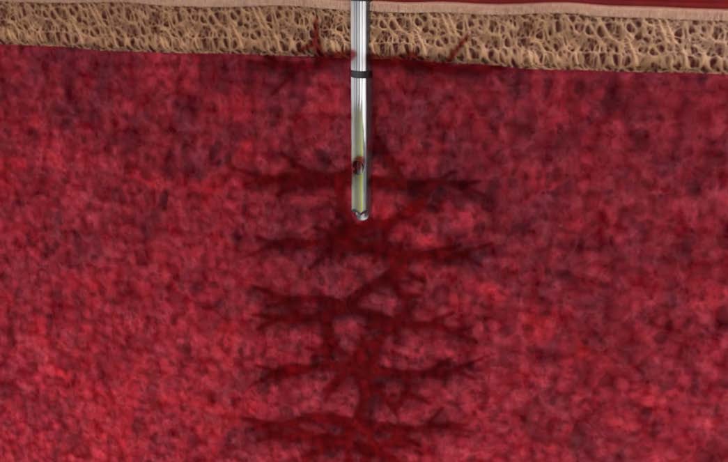 Marrow Cellution closed distal tip bone marrow aspiration cannula