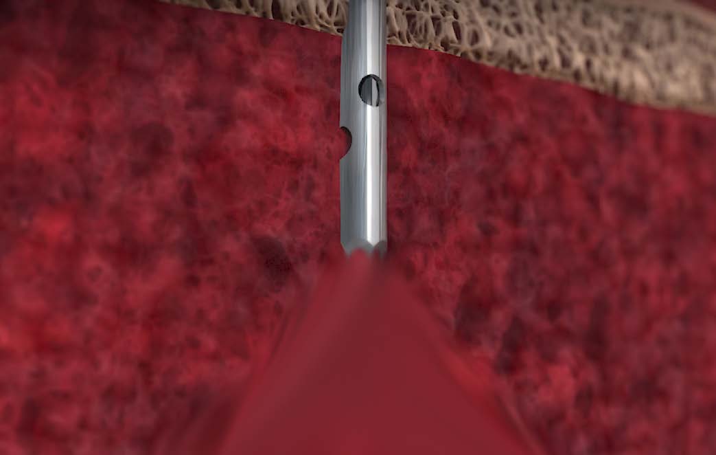 Traditional open tip trocar needle drawing peripheral blood in alongside marrow
