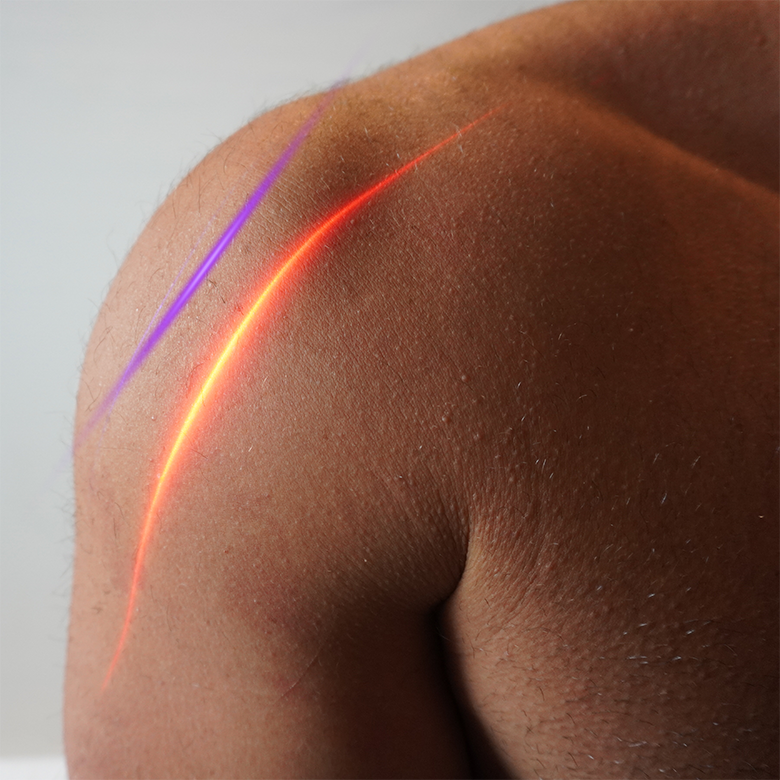 EVRL laser being applied in a clinical treatment