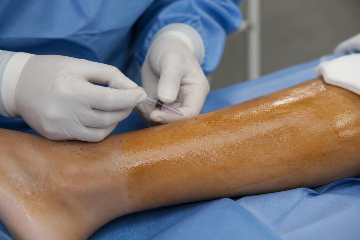 Gloved hands inserting a needle into a prepped lower leg compartment under sterile technique