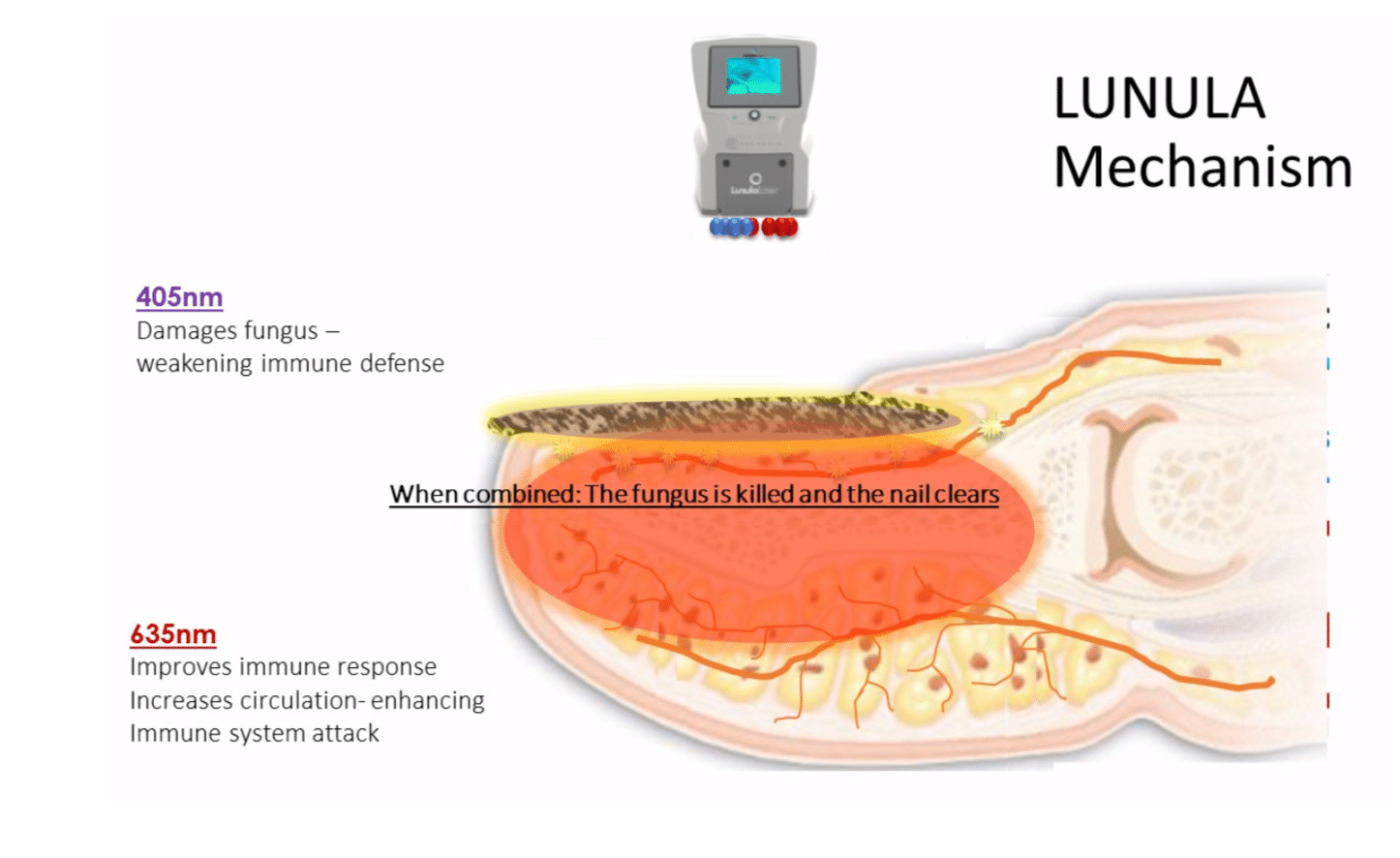 Lunula Laser Webinar